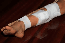 Snakebite Prevention and Treatment Snakebite Prevention and Treatment