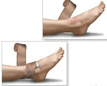 Snakebite Prevention and Treatment Snakebite Prevention and Treatment