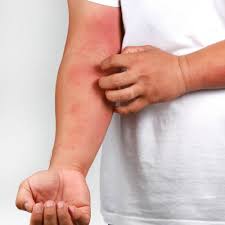 Fish Allergy: Implications for Aquaculture and Food Safety Fish Allergy: Implications for Aquaculture and Food Safety