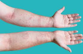 Fish Allergy: Implications for Aquaculture and Food Safety - Agric4Profits